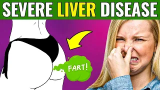 17 SIGNS that your LIVER is DYING | DANGEROUS!