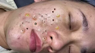 Relax Skincare Everyday with Acne Blackheads Treatment Spa #97915