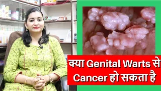 महिलाओं में Genital Warts क्यों होता है | Genital Warts in Female | Genital Warts Treatment in Hindi