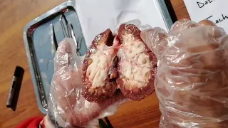 Disection Of Kidney