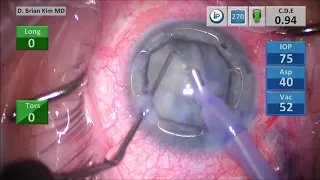 Diamatrix Iris Speculum: 1st Impression. Small Fibrotic Pupil, White Cataract