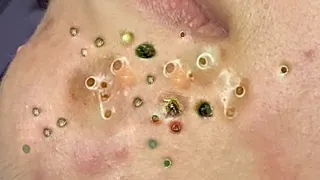 Make your Acne Treatment | Acne  spa  680 | Acne  spa Treatment