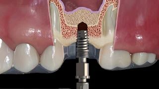 Sinus Lift Kit being used guided