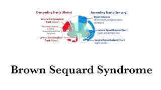 Brown Sequard Syndrome