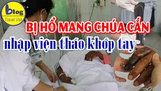 Thêm một trường hợp bị rắn hổ mang chúa cắn phải tháo khớp tay