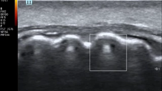 scanning a tooth with ultrasound