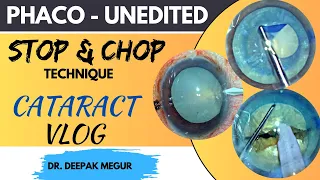 Complete case of managing Intumescent cataract (Stop & Chop technique) Cataract Vlog