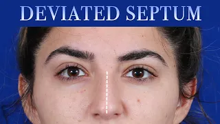 How To Fix A Deviated Septum | Dr  Moustafa Mourad | Mourad NYC