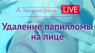 Лазерное удаление папиллом на веках - Periscope