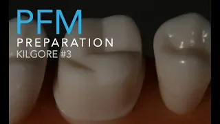 Molar Ceramo-Metal Preparation | How to Prepare a PFM On a Maxillary Molar