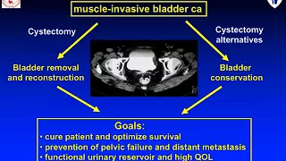 Integration of radiotherapy in muscle-invasive bladder cancer