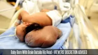 Baby Born With Brain Outside His Head -- VIEWERS' DISCRETION ADVISED
