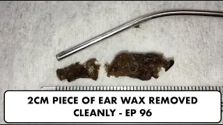 2CM PIECE OF EAR WAX REMOVED CLEANLY - EP 96