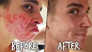 MY SKIN STORY