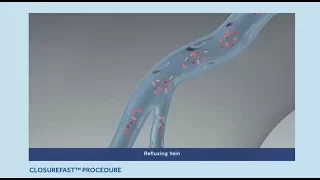 Varicose Veins Treatment: ClosureFast Procedure Animation