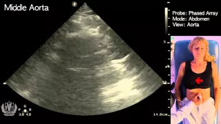 How to Perform Ultrasound of the Aorta -STEP by STEP