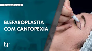 BLEFAROPLASTIA COM CANTOPEXIA: RELATO DE UM CASO COMPLEXO | DR. LAERTES THOMAZ JR.