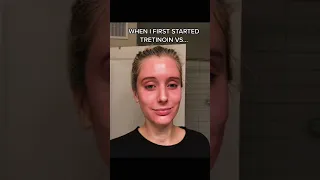 Tretinoin Transformation!