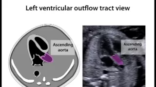 Left Ventricular Outflow Tract View (11.9)