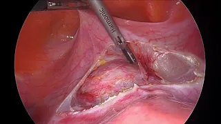 Bladder reflection during laparoscopic hysterectomy