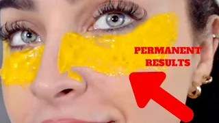 I Removed DARK CIRCLES in 5 Days with NATURAL INGREDIENTS!! DIY REMEDY [100% WORKS]+ puffy/wrinkles