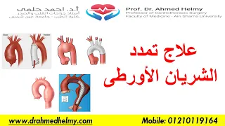 علاج تمدد الشريان الأورطى