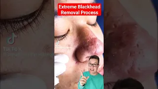 There Is Something Wrong - EXTREME BLACKHEAD REMOVAL #shorts