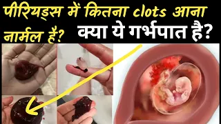 पीरियड में कितना clots आना नार्मल है? मिसकैरेज के समय कैसे clot निकलता है? Clots During Periods