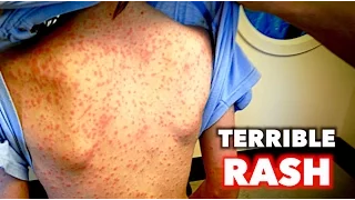 TERRIBLE Full Body Rash | Dr. Paul