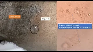 Ringworm and its causative agent dermatophyte  under microscope