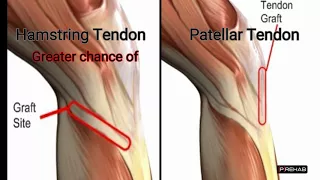 ACL Reconstruction Graft Options