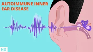 Battling Autoimmune Inner Ear Disease: Treatment Options and Prognosis