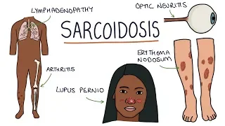 Understanding Sarcoidosis: A Visual Guide for Students