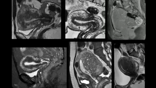 Adenomiose pela RM