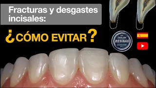 Fracturas y desgastes incisales: ¿cómo evitar?