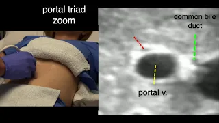 Gallbladder Scan Techniques, Subcostal Midclavicular Window