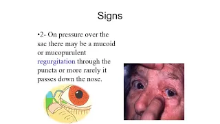 CHRONIC DACRYOCYSTITIS DR  GOTEKAR