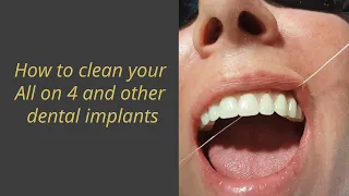How to clean your All on 4 and other Dental Implants