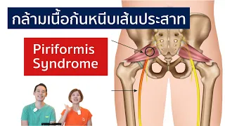 Piriformis Syndrome กล้ามเนื้อก้นหนีบเส้นประสาท ทำไมอาการเหมือนกระดูกทับเส้นประสาท | EasyDoc  EP.31