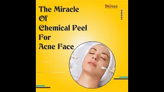 How Will Chemical Peel For Acne Face Be In The Future. #chemical_peeling #acne  #skinaaclinic