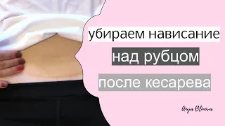 КАК УБРАТЬ ЖИВОТ ПОСЛЕ КЕСАРЕВА | пара простых процедур