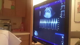 Six Weeks Ultrasound- Baby Heartbeat