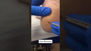 Satisfying painful hard corn removal by australian podiatrist