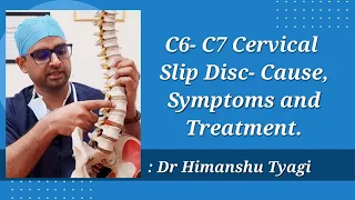 C6- C7 Cervical Slip Disc- Cause, Symptoms and Treatment.