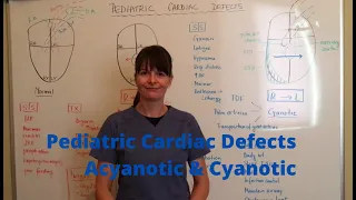 Pediatric cardiac defects - Acyanotic & Cyanotic