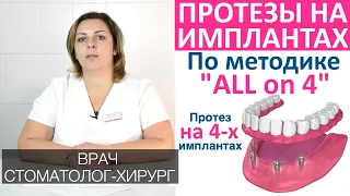 Протезирование зубов по системе «All on 4» (протез на четырех имплантах). Преимущества, показания.