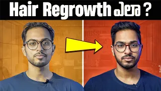 How I got my HAIR back... | FULL GUIDE on Minoxidil (Telugu)