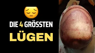 Die 4 größten Lügen der Haartransplantation - Mr. Hairtransplant