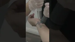 Laser Tattoo Removal - The First Treatment