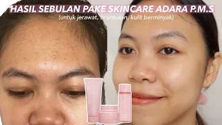 skincare untuk bruntus + jerawat! ADARA PMS review (pemakaian 1 bulan)